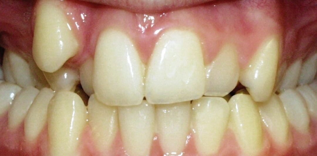 Bilateral-posterior-crossbite